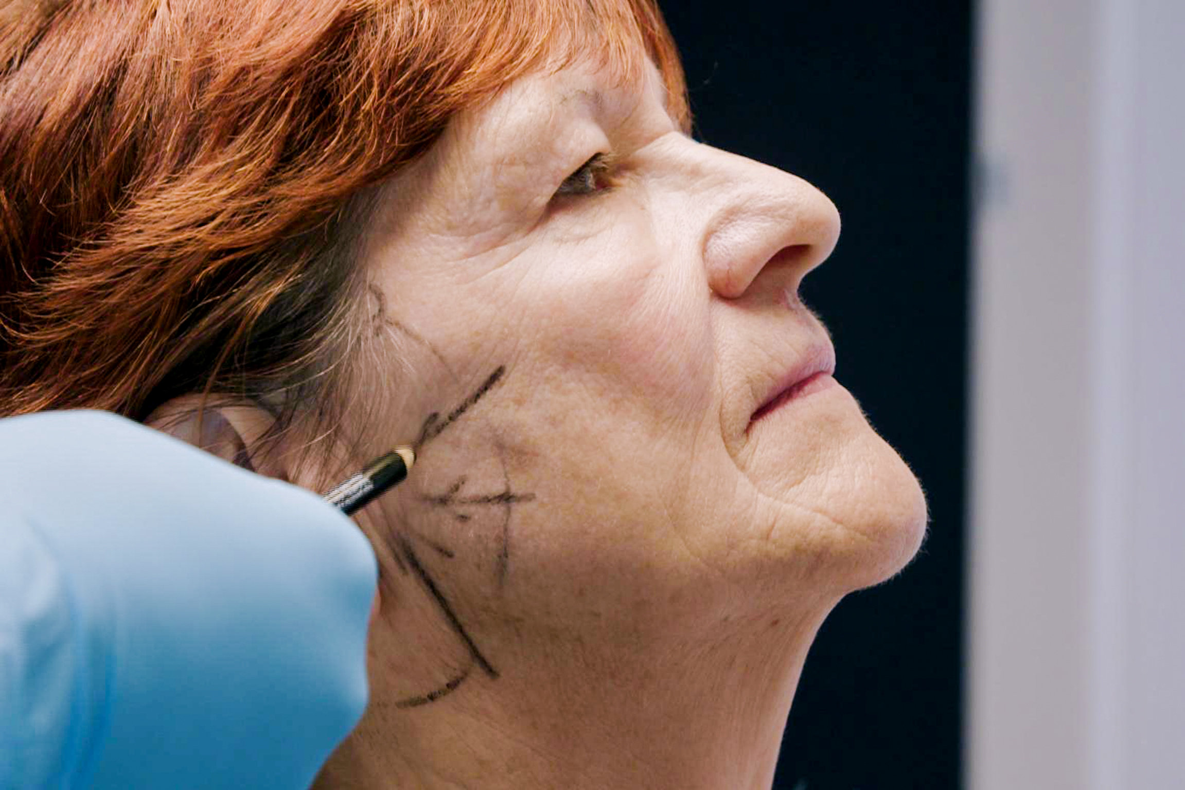 SRF DOK: Das optimierte Gesicht Maria Müller vor OP