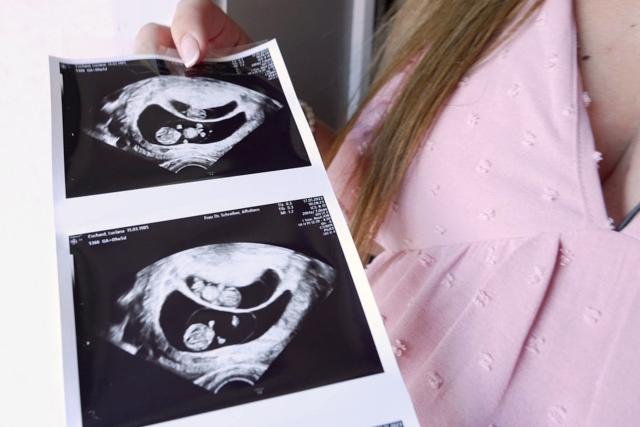 rec.Abtreibung bei Trisomie 21 – Frauen brechen ein TabuLuciana zeigt ihr Ultraschallbild.Copyright: SRF